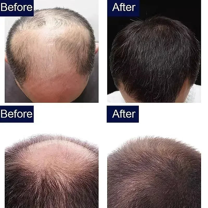 Hair Growth Serum Fast Growing Hair Essential Oil Beauty Hair Care 10/20/40ml Dense Regrowth Ginger Hair Promoting Regeneration